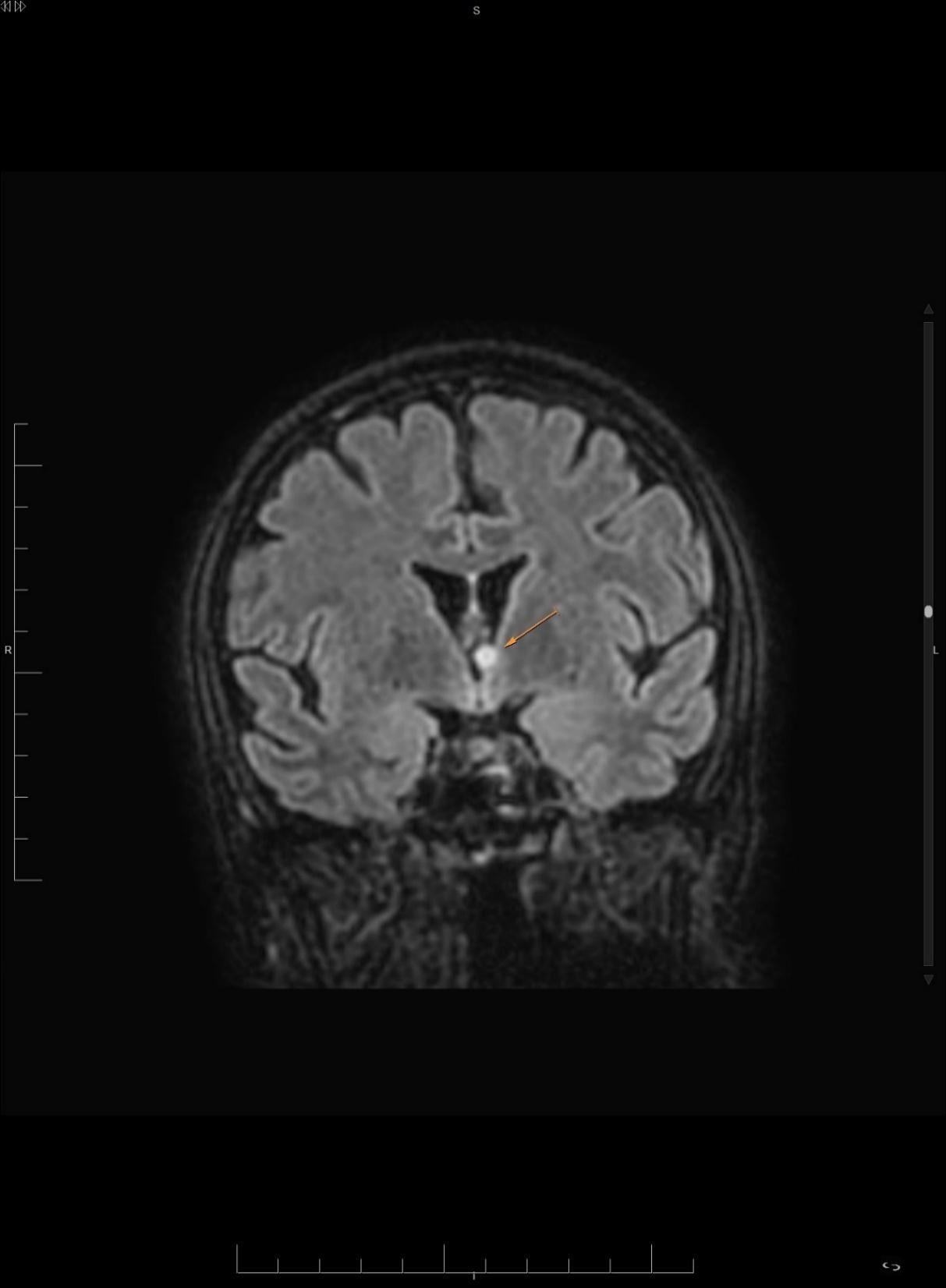 D:\CASOS REVISTAS\EMBOLISMO SÉPTICO PULMONAR\coronal FLAIR cerebro.jpg