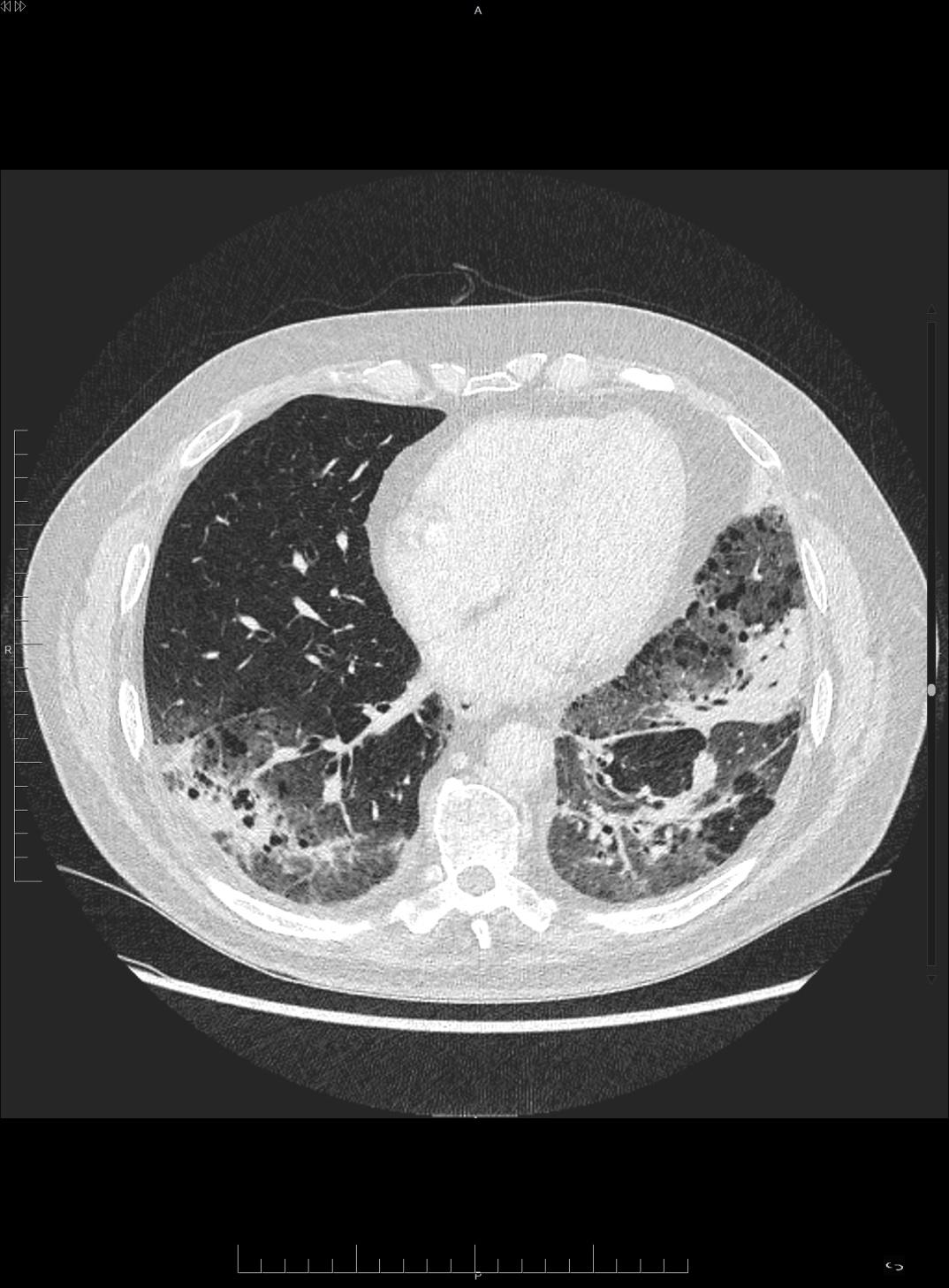 F:\CASOS REVISTAS\NOC\axiual pulmonar.jpg