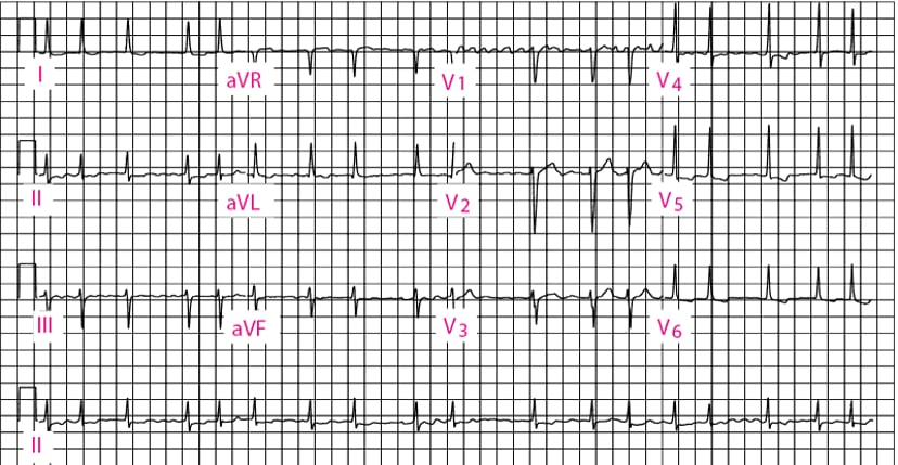 A graph of a heart rate
Description automatically generated