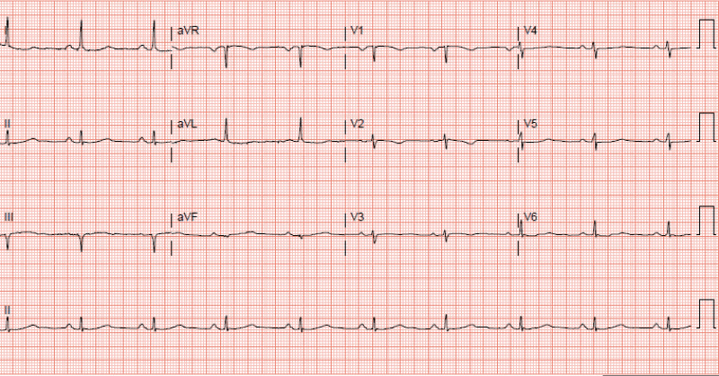 A graph of a heart rate
Description automatically generated