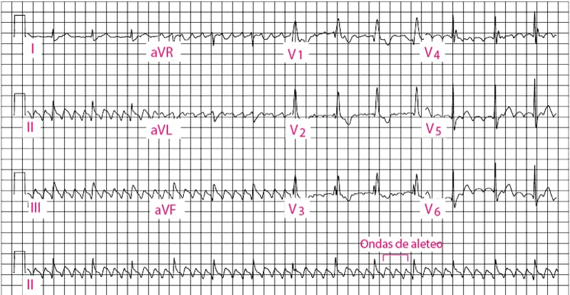 A graph of ecg lines
Description automatically generated