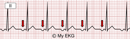 A graph with arrows pointing to the ecg
Description automatically generated
