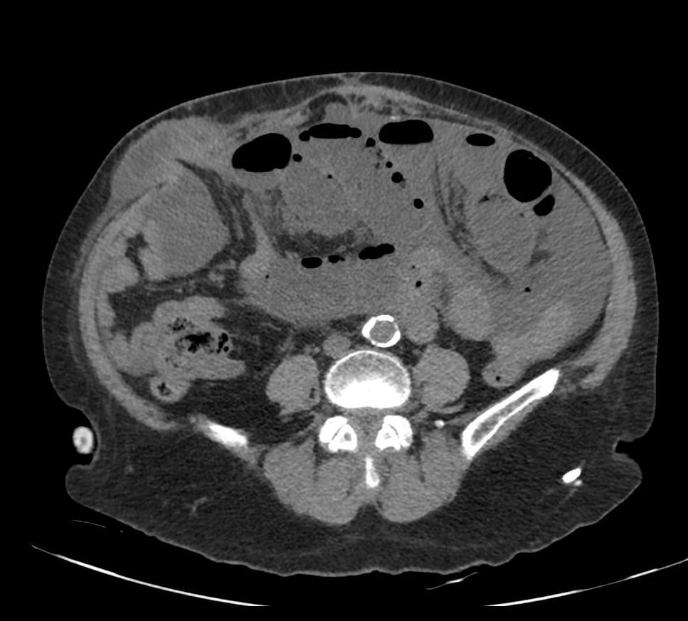 C:\Users\Carlota\Desktop\PEN PHILIPS\CONGRESO SERAM 2020\hernias\imagenes\imagenes\hernia de spieguel TC 622790.jpg