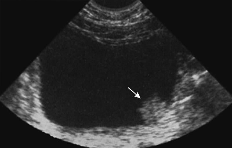 Cáncer de vejiga: diagnóstico y principios terapéuticos - ScienceDirect