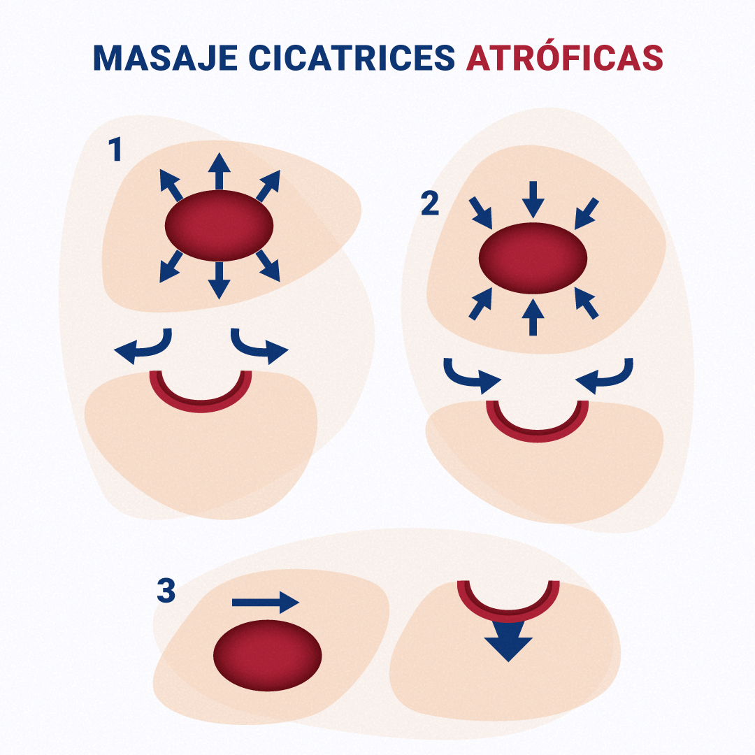 https://olyanfarma.es/wp-content/uploads/2020/12/3-masaje-cicatrices-atroficas-exscar.png