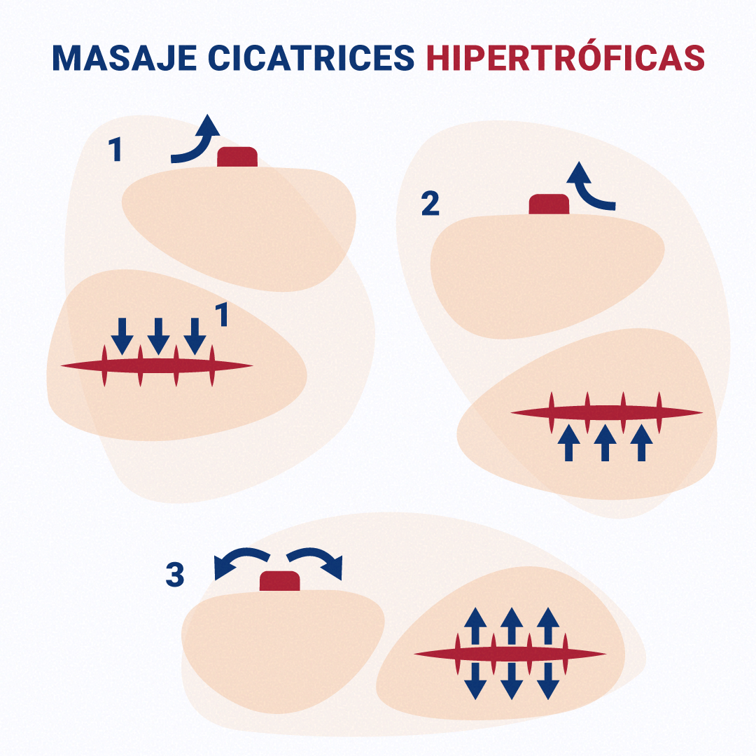 https://olyanfarma.es/wp-content/uploads/2020/12/4-masaje-cicatrices-hipertroficas-exscar.png
