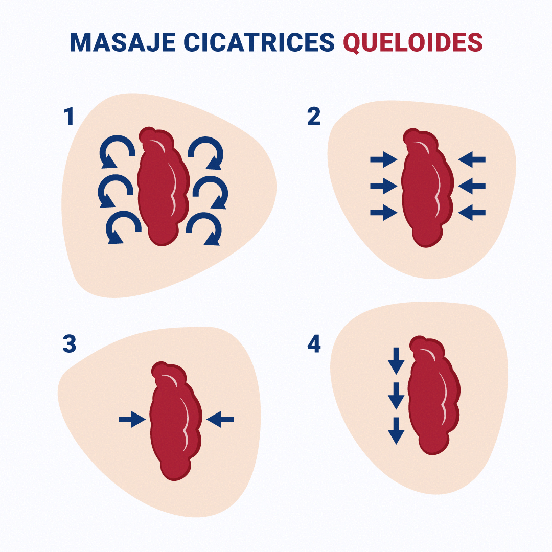 https://olyanfarma.es/wp-content/uploads/2020/12/5-masaje-cicatrices-queloides-exscar.png