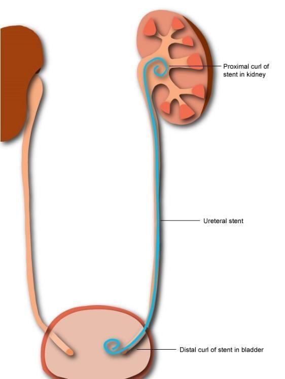 Lo que tienes que saber del Doble J - Urología Albella