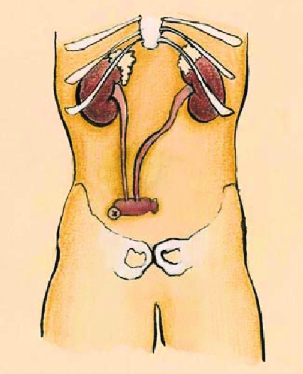 Ureteroileostomía tipo Bricker. | Download Scientific Diagram