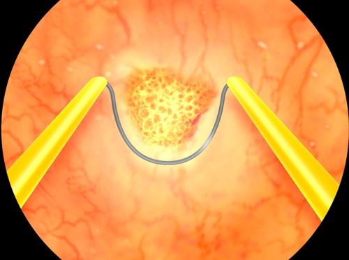 Video - Resección transuretral del tumor de vejiga (RTU o RTUV)