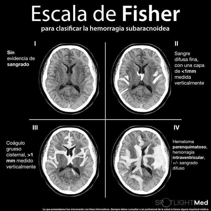 Vicente Martín on Twitter: "@PdfRadiologia Actualmente se usa mayoritariamente la escala de Fisher modificada. Se correlaciona mejor con el pronóstico de los pacientes. (Stroke. 2001;32:2012-2020.) https://t.co/FbbkvwTzBm" / Twitter