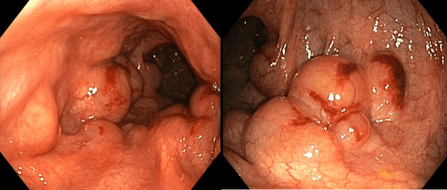 G:\Mi unidad\AINARA\TRABAJO\FUTURAS PUBLICACIONES\ARTICULOS\RSI\FOTO neumatosis.png