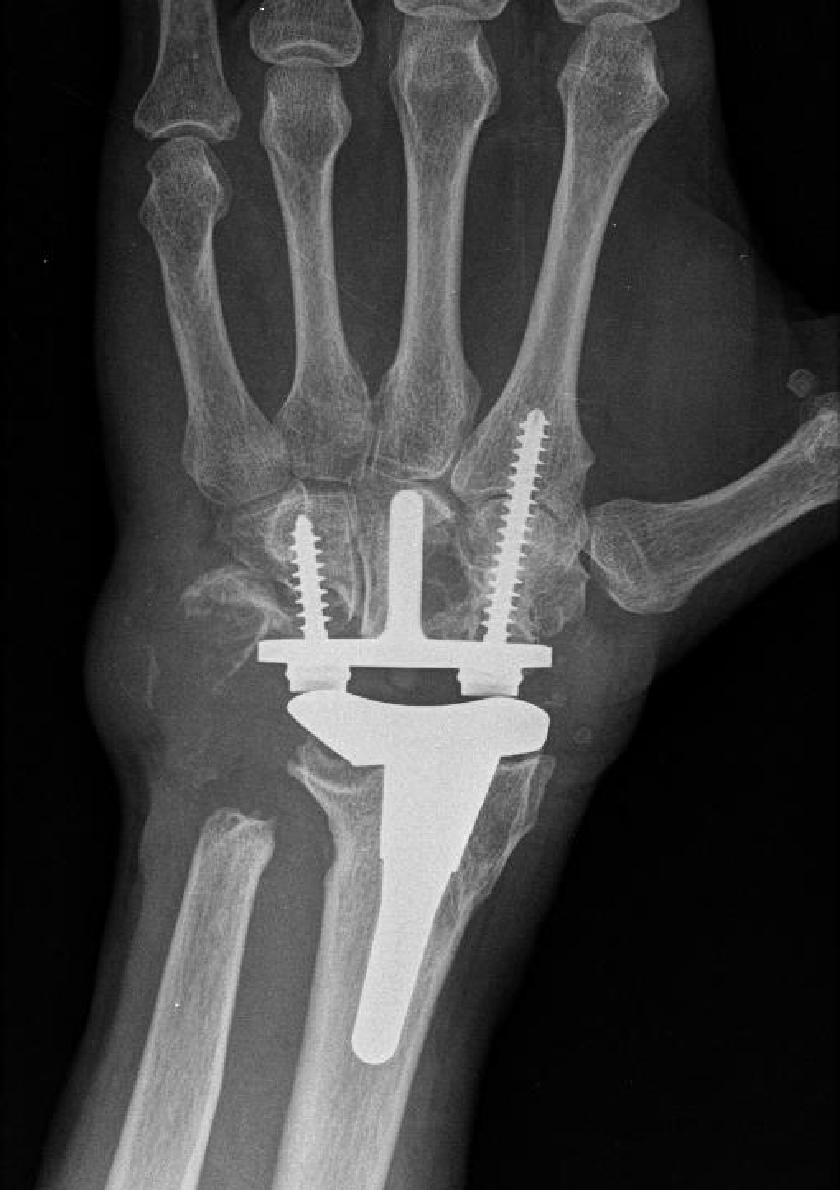 Artrodesis De Rescate Para Pr tesis Total De Mu eca Fallida A Artrodesis De Rescate Para Pr tesis Total De Mu eca Fallida A