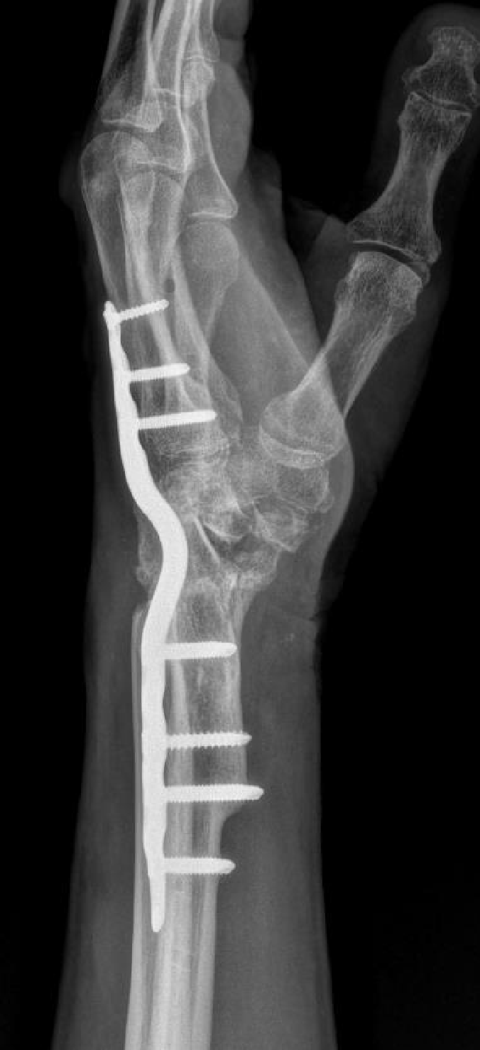 Artrodesis De Rescate Para Pr tesis Total De Mu eca Fallida A Artrodesis De Rescate Para Pr tesis Total De Mu eca Fallida A