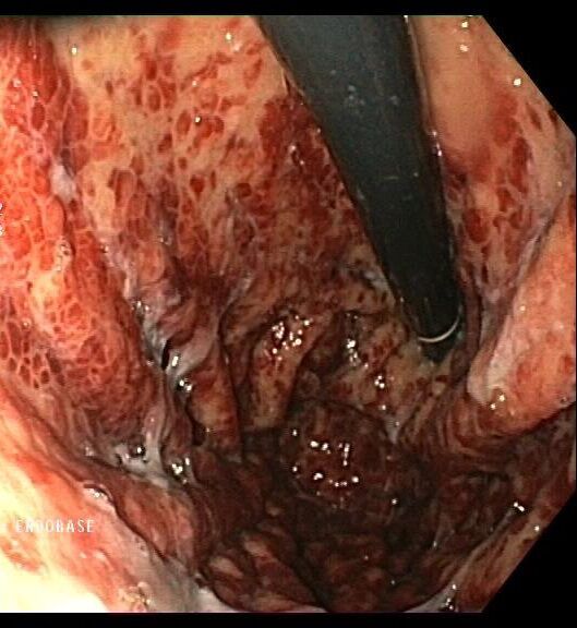 D:\LIBROS DIGESTIVO\ENDOSCOPIA\CASO CLÍNICO SED\MARTINEZ_JOAQUIN JOSE_GASTROSCOPIA_20230623_1077961.JPG