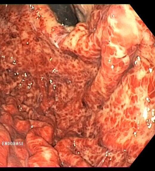 D:\LIBROS DIGESTIVO\ENDOSCOPIA\CASO CLÍNICO SED\MARTINEZ_JOAQUIN JOSE_GASTROSCOPIA_20230623_1077963.JPG