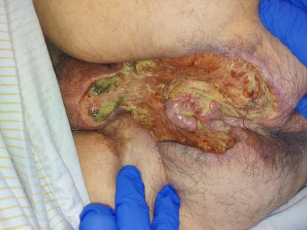 G:\HOSPITAL\ACIRCAL 2024\p3. ULCERA ANAL RYM COLAGENASA\PHOTO-2024-03-27-19-24-03.jpg