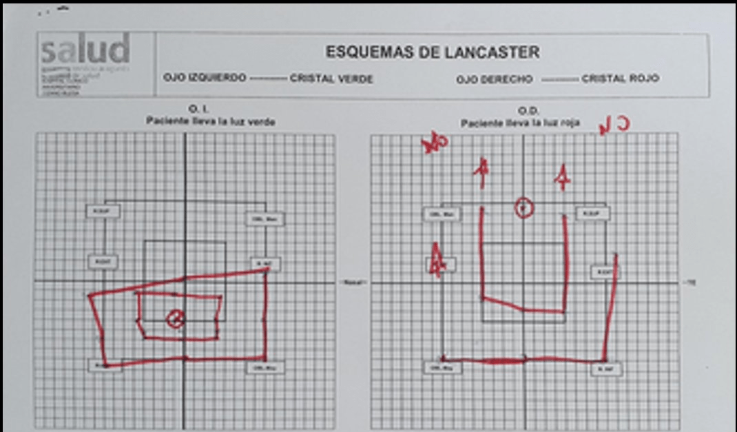Anexo 1. Esquema de Lancaster preoperatorio. Se aprecia marcada limitación de la elevación del ojo izquierdo con campo de diplopía superior amplio.