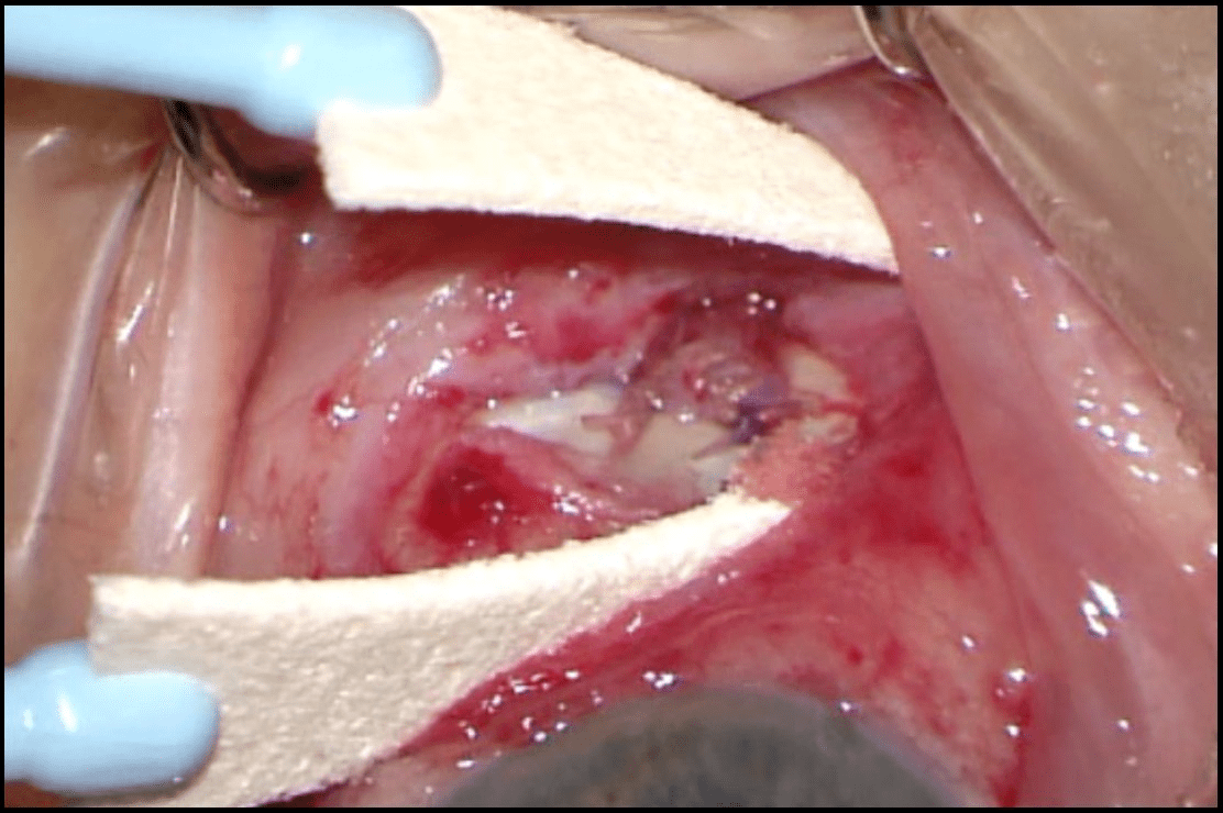 Anexo 3. Imagen intraoperatoria: apertura conjuntival con exposición de tejido cicatricial periocular. La sección del tejido fibroso produjo mejoría inmediata de la ducción.
