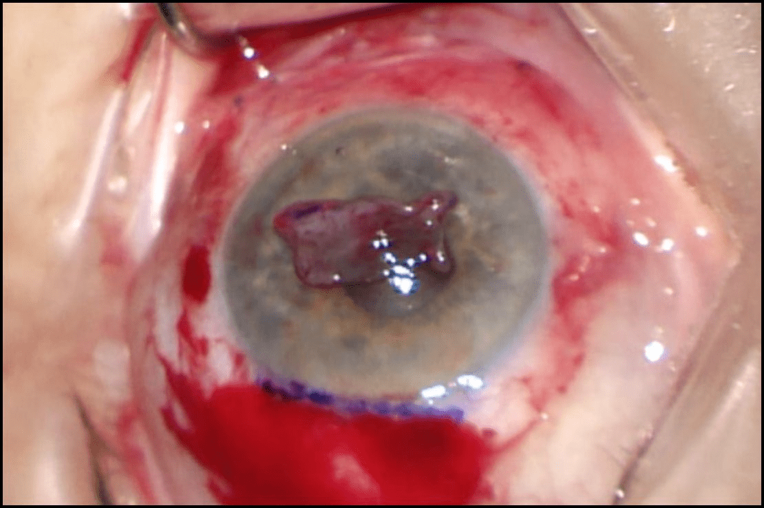 Anexo 4. Imagen intraoperatoria: aspecto del globo ocular tras retrocesión de 3 mm del músculo recto inferior izquierdo.