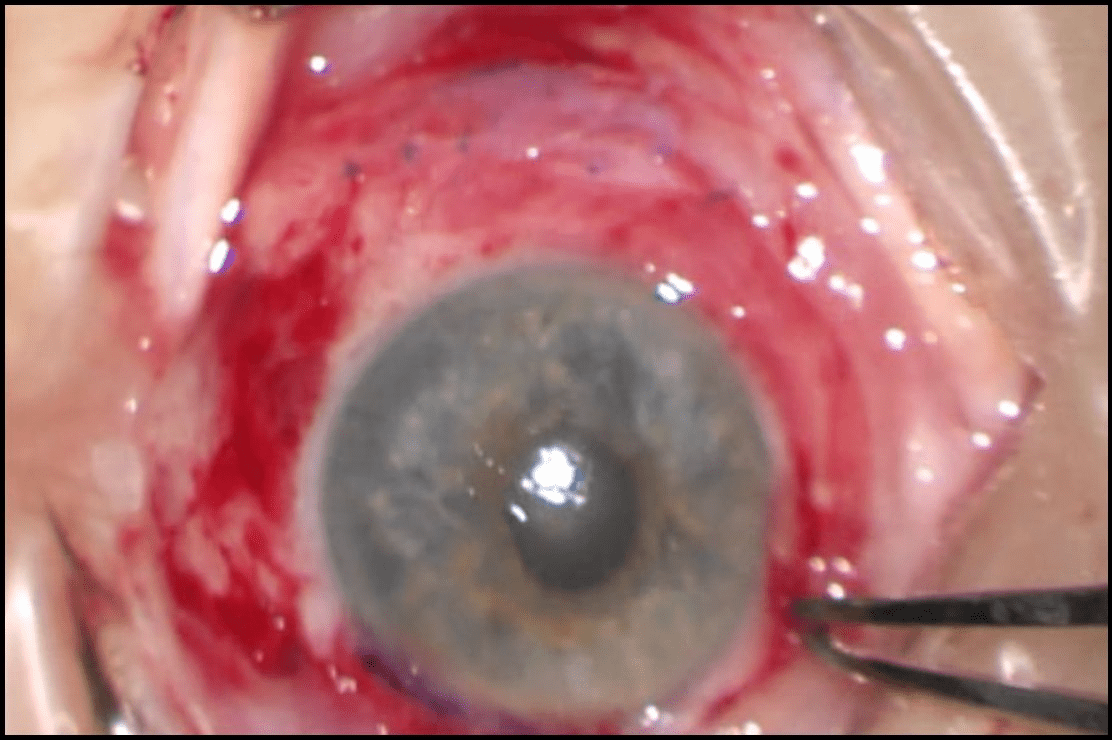 Anexo 5. Imagen intraoperatoria: colocación del injerto conjuntival autólogo fijado con adhesivo tisular de fibrina sobre el defecto conjuntival.