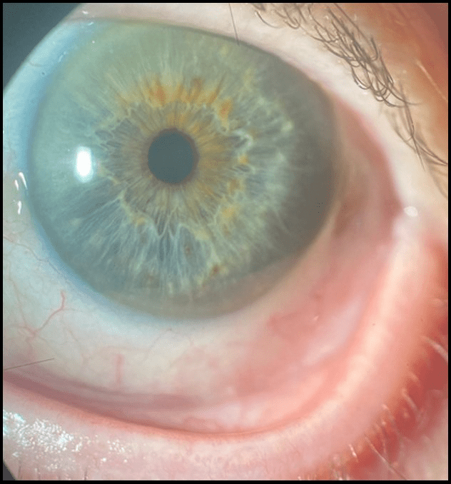 Anexo 6. Imagen en lámpara de hendidura: aspecto postoperatorio del injerto conjuntival integrado.