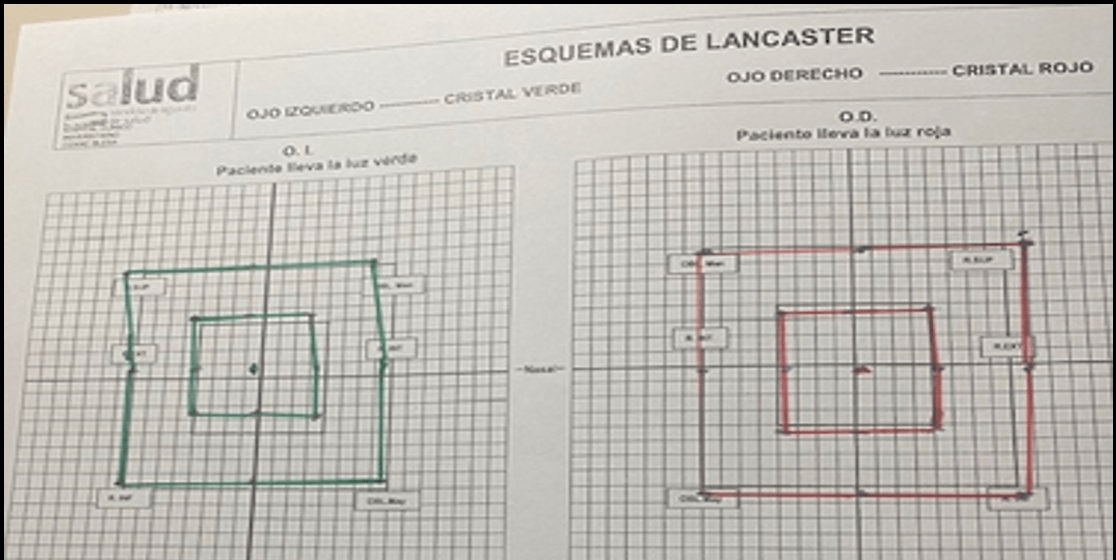 Anexo 7. Esquema de Lancaster postoperatorio al mes de la intervención. Se aprecia normalización del campo de motilidad con ortotropia en posición primaria.